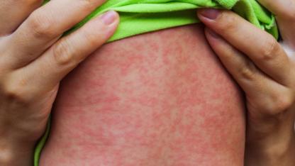 Attēls rakstam: Latvijā reģistrēts pirmais masalu uzliesmojums kopš 2018. gada