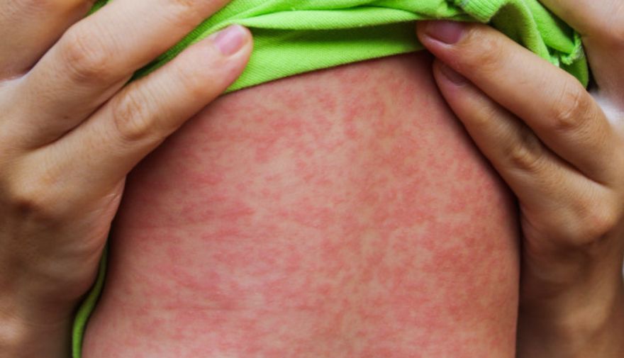 Latvijā reģistrēts pirmais masalu uzliesmojums kopš 2018. gada