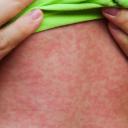 Attēls rakstam: Latvijā reģistrēts pirmais masalu uzliesmojums kopš 2018. gada