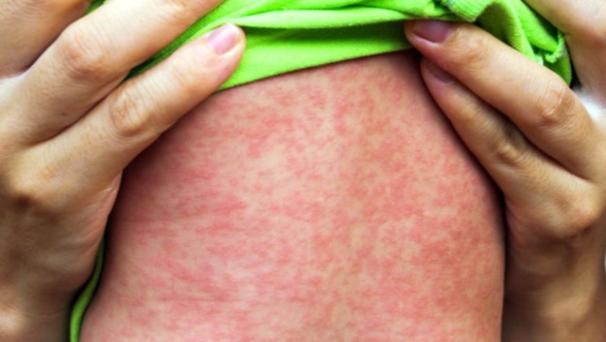 Latvijā turpinās masalu uzliesmojums; reģistrēti jau 24 saslimušie