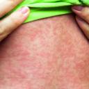 Attēls rakstam: Latvijā turpinās masalu uzliesmojums; reģistrēti jau 24 saslimušie