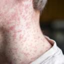 Attēls rakstam: Masalu uzliesmojumā pieaudzis saslimušo skaits