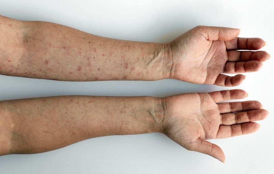 Pieci ādas iekaisumu veidi vasarā – kā tos novērst? Skaidro farmaceits