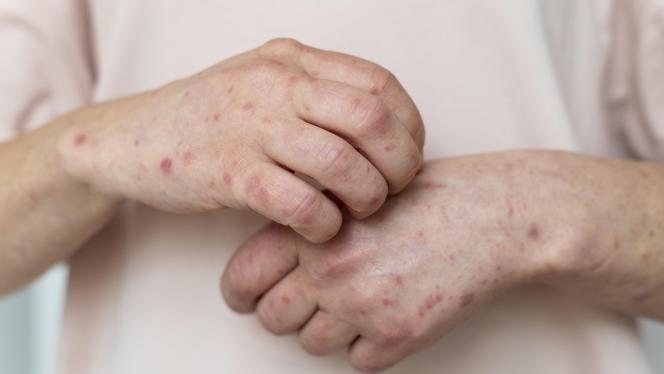 Attēls rakstam: SPKC brīdina: masalas turpina strauji izplatīties