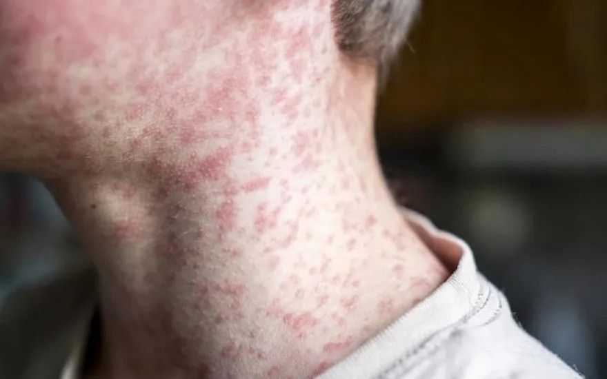 SPKC: Masalu tālākas izplatīšanās risks ir augsts