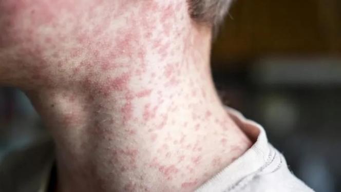 Attēls rakstam: SPKC: Masalu tālākas izplatīšanās risks ir augsts