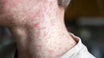 Attēls rakstam: SPKC: Masalu tālākas izplatīšanās risks ir augsts