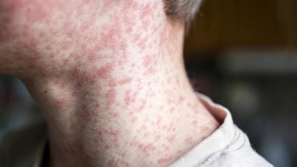 Attēls rakstam: SPKC saistībā ar laboratoriski apstiprinātu masalu gadījumu aicina atsaukties kontaktpersonas