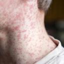 Attēls rakstam: SPKC saistībā ar laboratoriski apstiprinātu masalu gadījumu aicina atsaukties kontaktpersonas