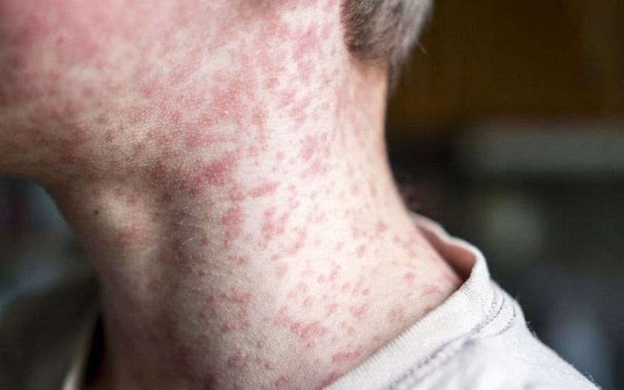 SPKC saistībā ar laboratoriski apstiprinātu masalu gadījumu aicina atsaukties kontaktpersonas