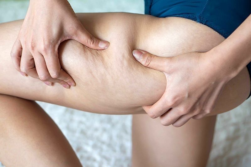 Vasaras sezonas bieds – celulīts. Vai pastāv brīnumlīdzekļi tā uzveikšanai?